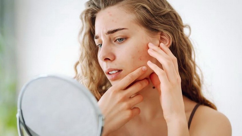 Chăm sóc da mụn hiệu quả trong thời tiết hanh khô của mùa Thu