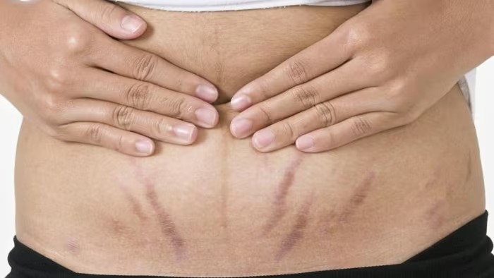 Rạn da sau sinh, nỗi ám ảnh khiến nhiều chị em mặc cảm với chồng