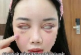 Cô gái không thể nhắm kín mắt sau 5 ngày cắt mí