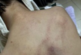 Đình chỉ thêm một giáo viên vụ bạo hành bé gái 4 tuổi