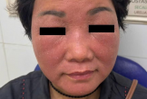 Mặt sưng đỏ vì viêm da tiếp xúc nặng do bôi thuốc không rõ nguồn gốc