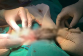 Phẫu thuật lấy búi tóc dài gần 20cm trong dạ dày bé trai